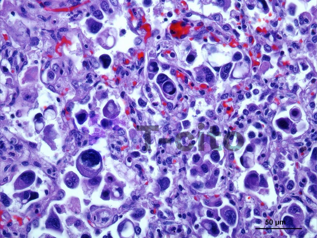 Carcinoma-anaplasico-mamario