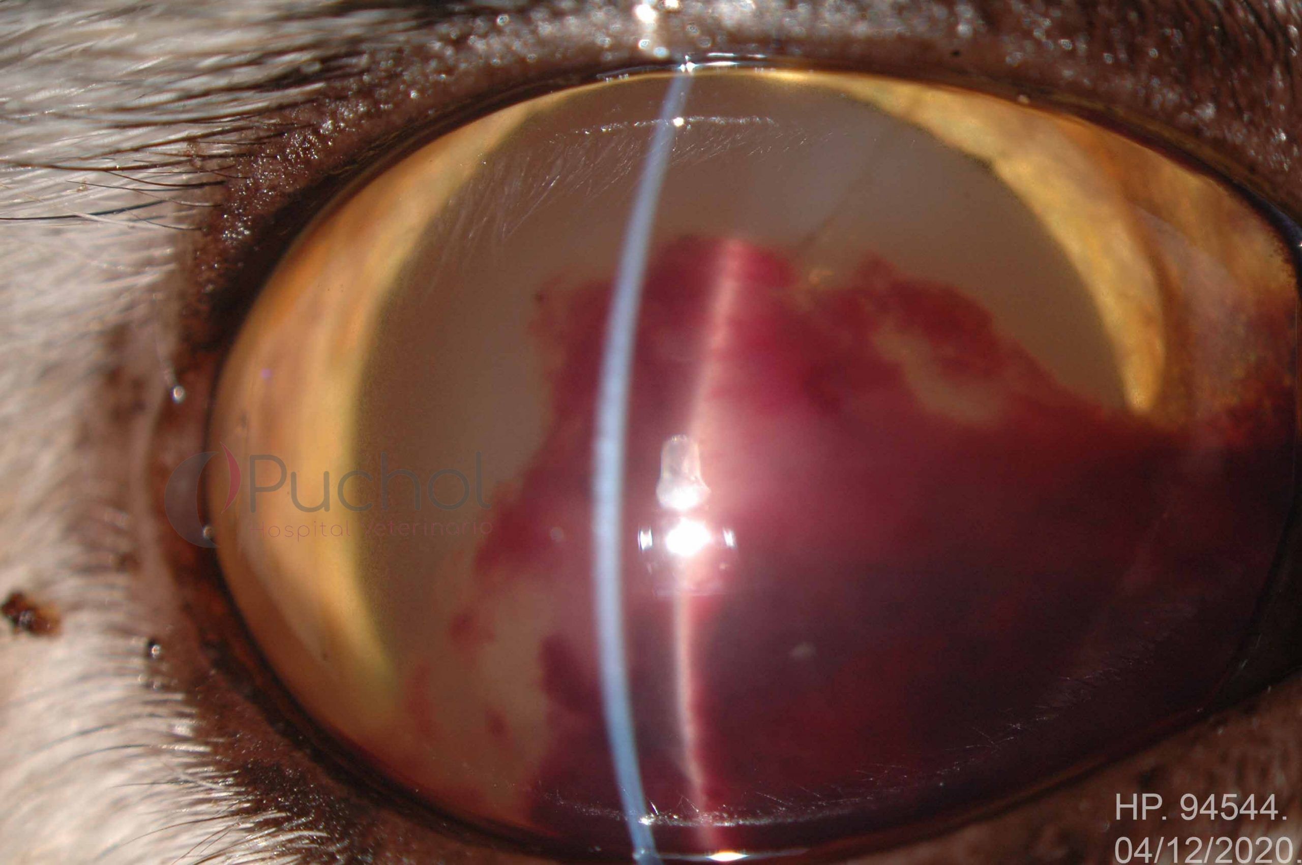 Hemorragia cámara anterior
