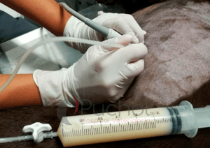 derrame pleural intervención