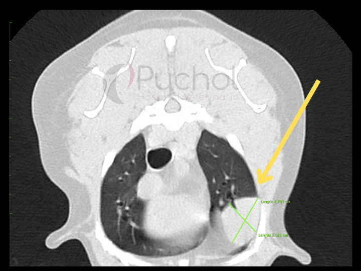 T.C con lesión pulmonar compatible con neoplasia. Cortesía Servicio de Diagnóstico por Imagen