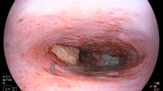 perro come piedras endoscopia imagen